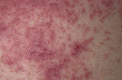 dermatitis herpetiformis Contributed by Wikimedia User: Madhero88 (CC BY-SA 3