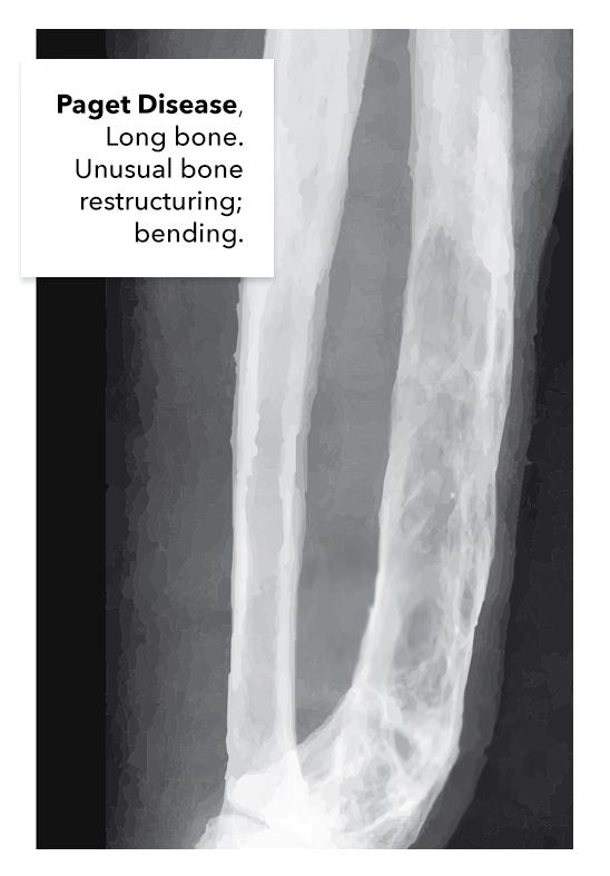 Figure Paget Disease Of The Long Bone Statpearls Ncbi Bookshelf 4296