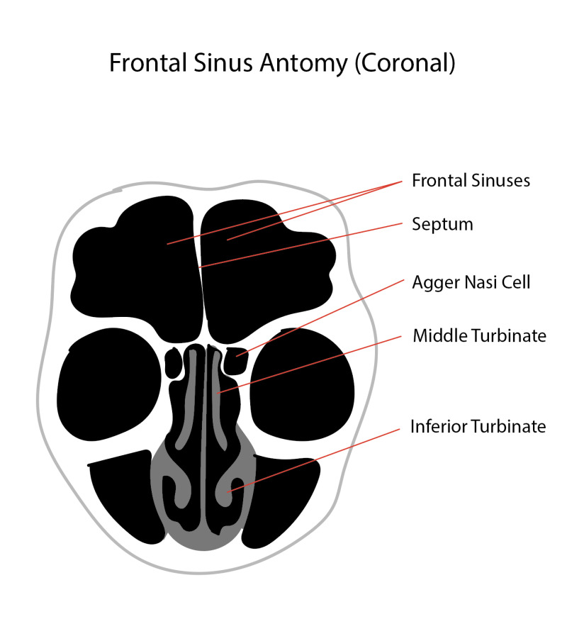 Figure Diagram Of The Frontal Sinus Anatomy Coronal Contributed By Rian Kabir MD StatPearls