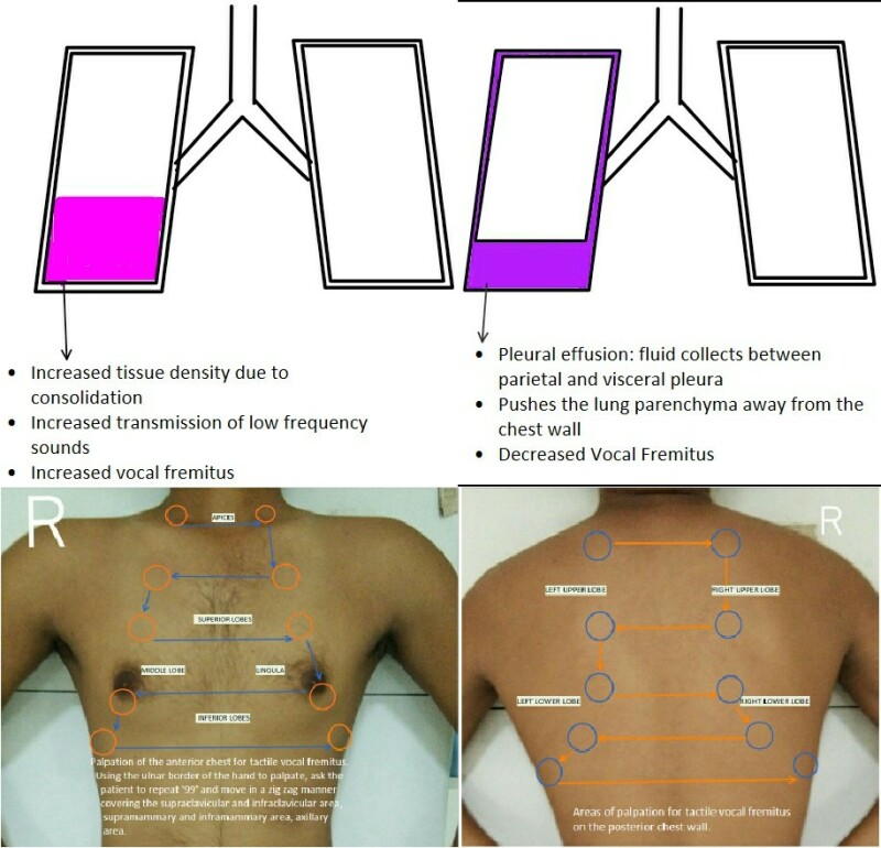 resonance lung sounds