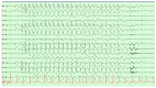 Electroencephalogram (EEG), Absence Epilepsy