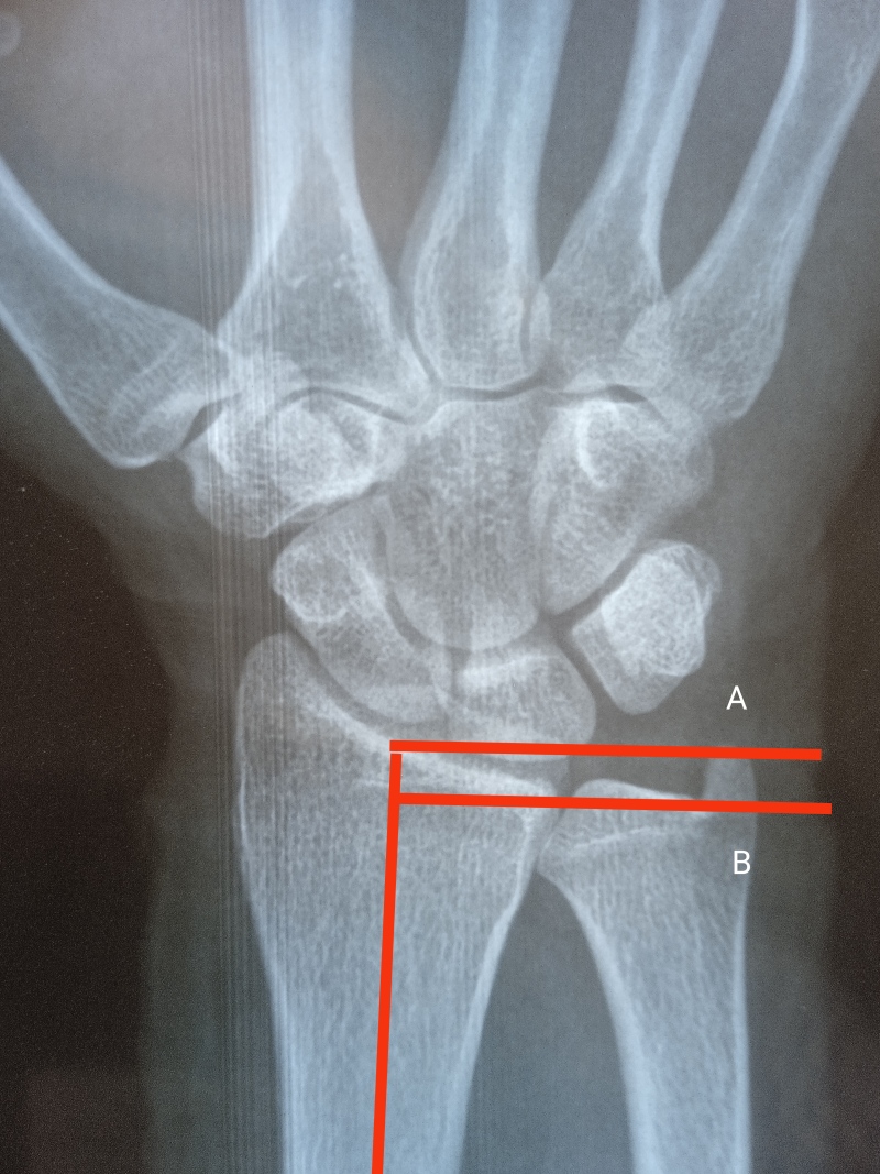 [Figure, Ulnar Variance: Both lines are...] - StatPearls - NCBI Bookshelf