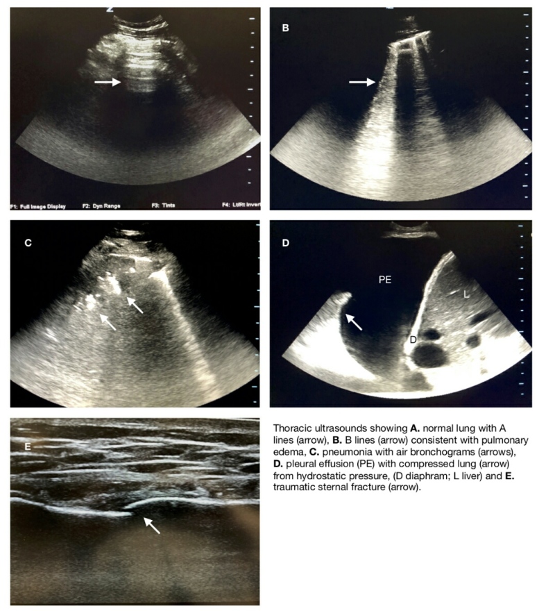 Figure Thoracic Ultrasound Contributed By Alan Taylor Md