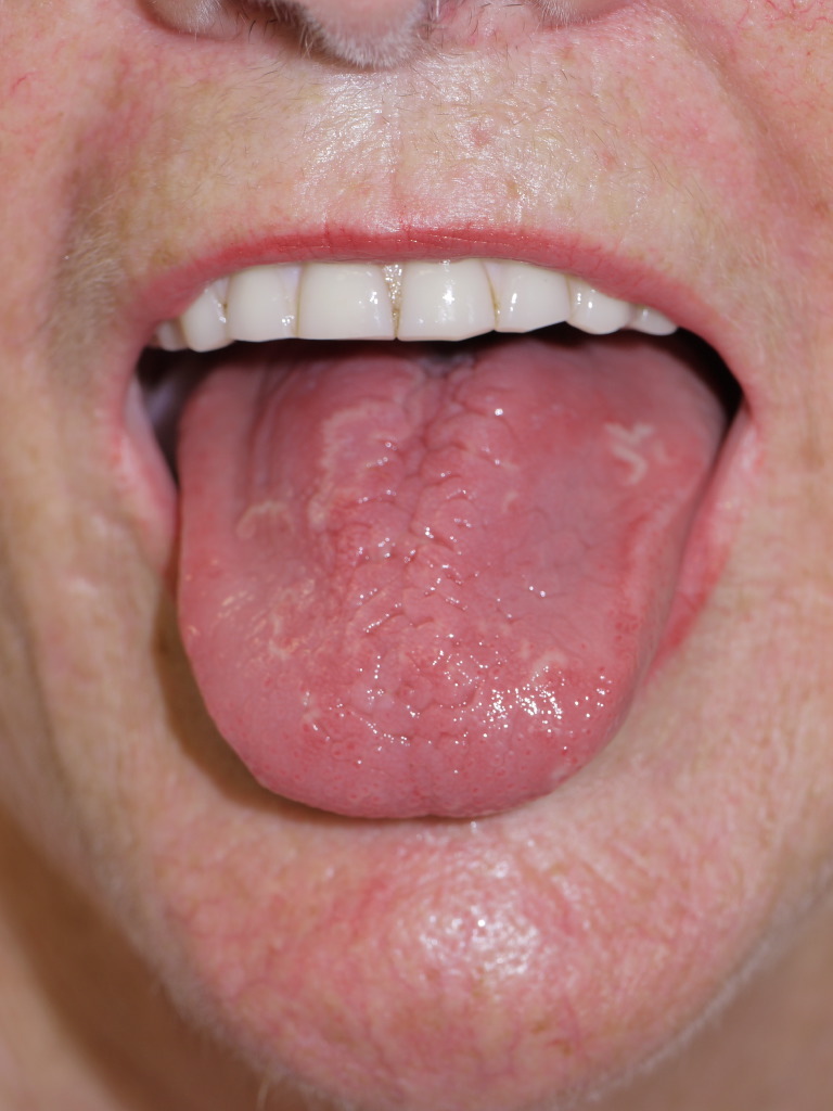 geographic tongue baby