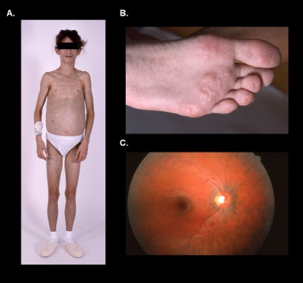 Multiple symmetric lipomatosis with vulvar involvement: a rare case report  associated with walking difficulty and urination disorder