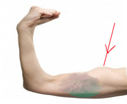 Figure Biceps Tendon Rupture Image Courtesy O Chaigasame Statpearls Ncbi Bookshelf