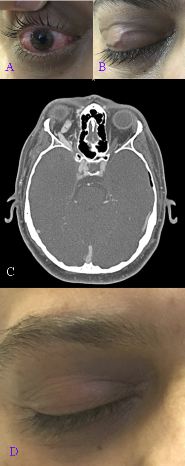 Epidural Hematoma Statpearls Ncbi Bookshelf