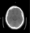 CT head Epidural Hematoma