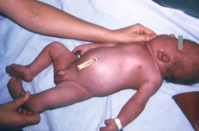 apert syndrome newborn