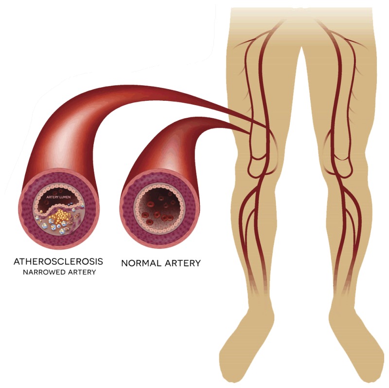 Disease peripheral artery Peripheral artery