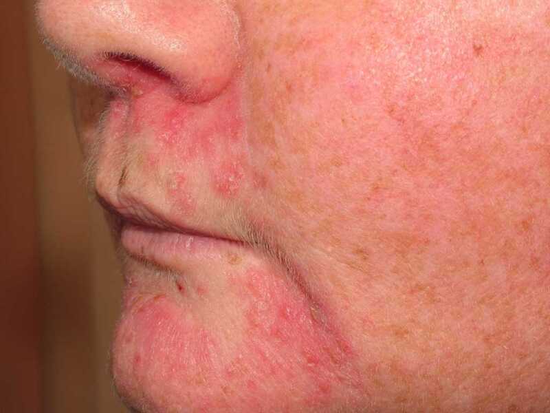 perioral dermatitis chin