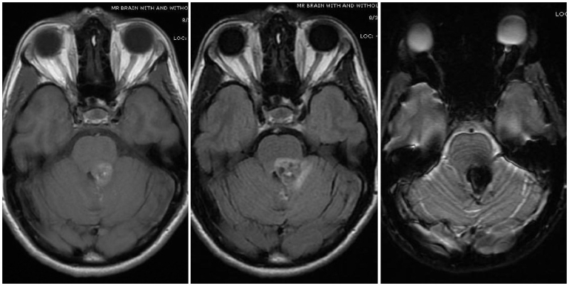 cerebellar peduncle mri