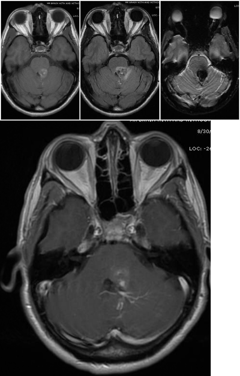 Cavernous Venous Malformation Statpearls Ncbi Bookshelf