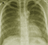 Chest X-ray of Mycobacterium Avium-Intracellulare Pneumonia