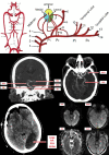 posterior cerebral artery territory