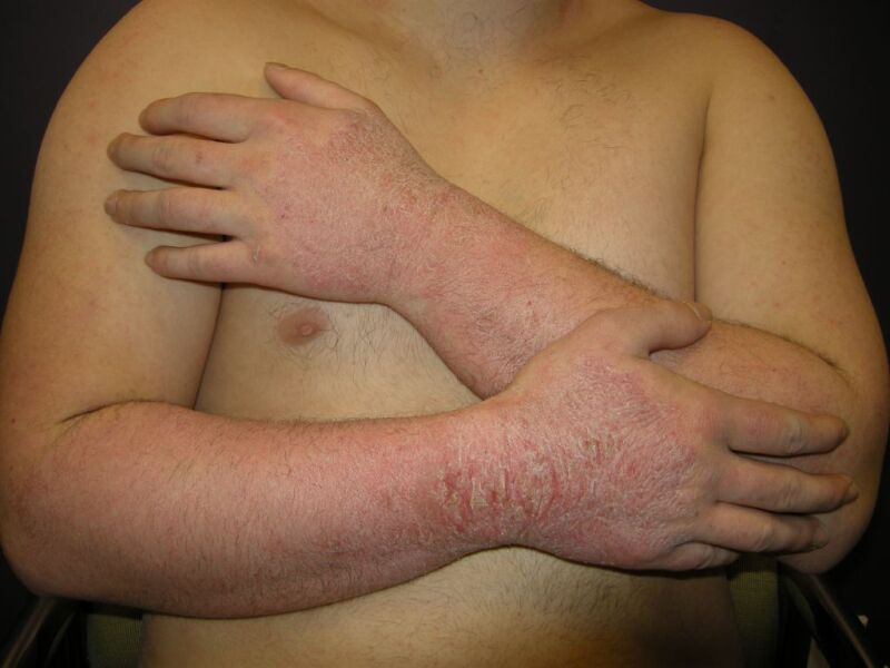 Rubber Allergy, Allergic Contact Dermatitis (Contact dermatitis, rubber) -  Dermatology Advisor