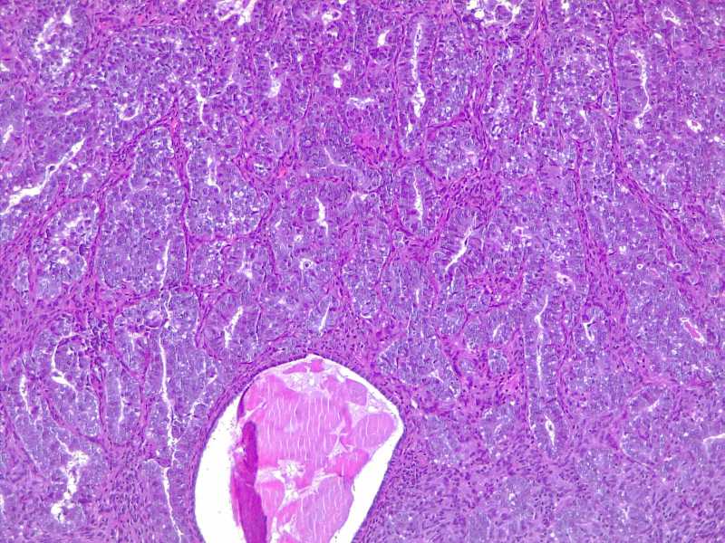 Figure Uterus Endometrial Carcinoma 4x He Contributed By Fabiola Farci Md Statpearls 8395