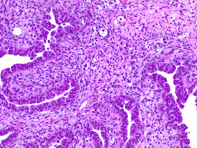 Figure Uterus Adenosarcoma 4x He Contributed By Fabiola Farci Md Statpearls Ncbi 9161