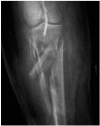 FIGURE 19.1. Severe comminuted fracture of the tibia and fibula with distal popliteal artery injury demonstrated angiographically. An injury with a high risk of acute limb compartment syndrome.