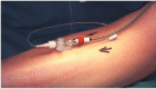 FIGURE 19.5. Slit catheter inserted into anterior tibial compartment and connected to a pressure transducer. (Photograph courtesy of Mr MJ Allen.).