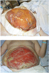 FIGURE 9. a) Immediate containment of abdominal contents using plastic bowel bag after decompressive laparostomy following ruptured abdominal aortic aneurysm repair. b) The same wound after 4 weeks, the viscera having granulated over.