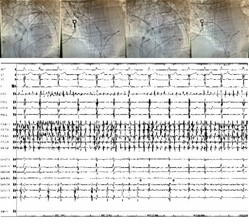 Figure Pulmonary Vein Radiographs And Ekg Contributed By Mena Yacoub Statpearls Ncbi 8217