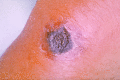 A skin lesion caused by anthrax
