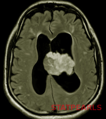 Image choroid__plexus__papilloma