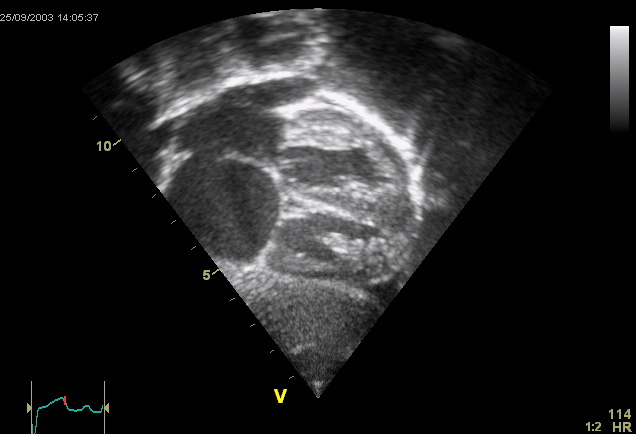 This is an ultrasound picture of the heart, an echocardiogram