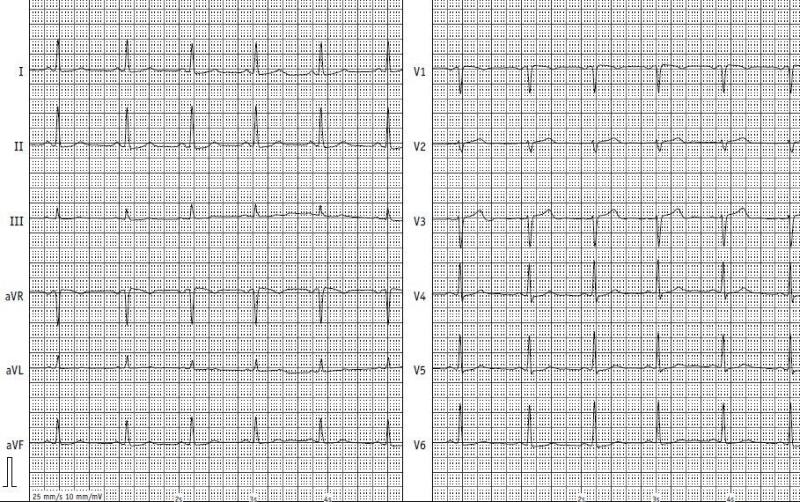 Illustration: Normal ECG – Left: the leads from the arms and legs, Right: the leads from the chest wall. Source: CCB Frankfurt a.M.