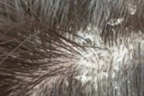 Tinea capitis of the scalp showing black-dots picture