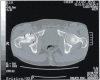 Dysbaric Osteonecrosis, CT scan Contributed by JIANG et al, UHM 2005, Vol