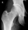 Dysbaric Osteonecrosis of the Hip Contributed by UHM 2005, Vol