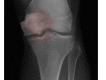 Spontaneous Osteonecrosis of the Knee