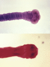 Figure, Hookworm infection Image courtesy O.Chaigasame] - StatPearls - NCBI  Bookshelf