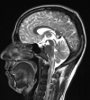 Neurocysticercosis in the CSF pathways