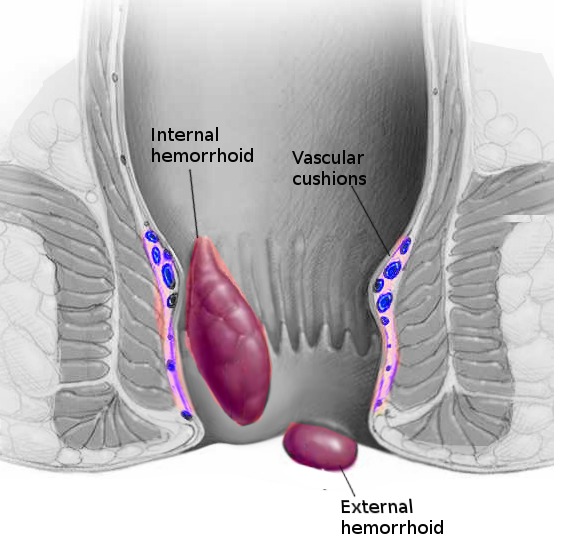 internal vs external hemorrhoids