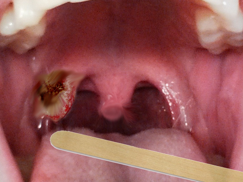 tonsil cancer hpv