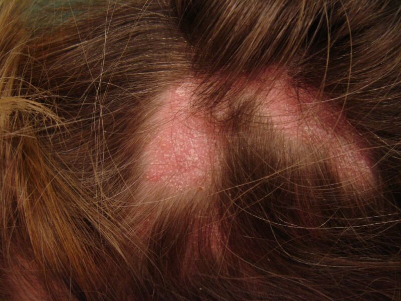 lichen planus scalp