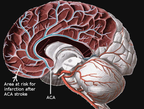 anterior cerebral artery stroke case study