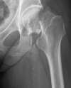 femoral neck fracture symptoms