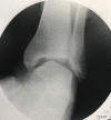 An ankle stress radiograph under live fluoroscopy showing lateral ankle instability with nearly a 40-degree talar tilt angle