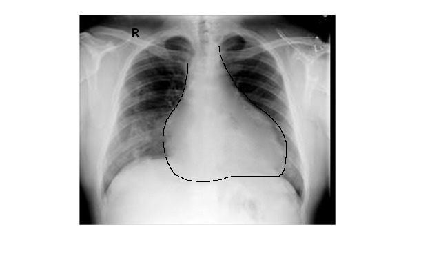 pericardial effusion x ray