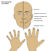 Gigantism and Acromegaly - StatPearls - NCBI Bookshelf