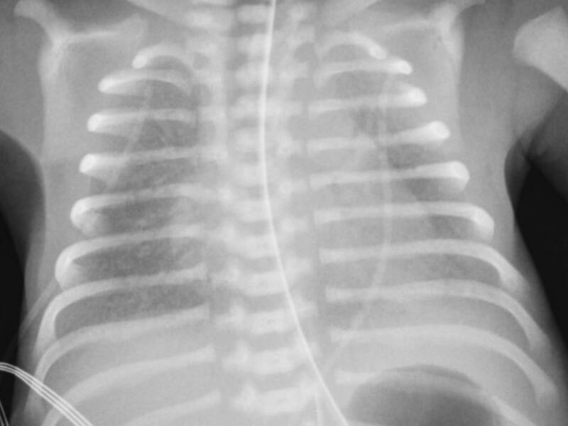 respiratory distress syndrome x ray