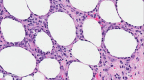 Subcutaneous Panniculitis