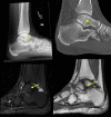 Top left: Lateral radiograph of the ankle shows a subtle lucency through the talar dome and body (arrows), consistent with a non-displaced fracture