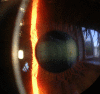slit lamp image of cornea, iris and lens