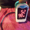 This image show a Pulse Oximeter with 98% oxygen saturation level and pulse/HR of 52 bpm