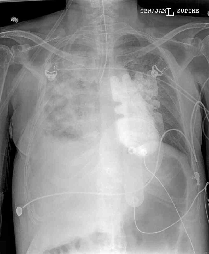 figure-chest-radiograph-endotracheal-tube-right-mainstem-bronchus